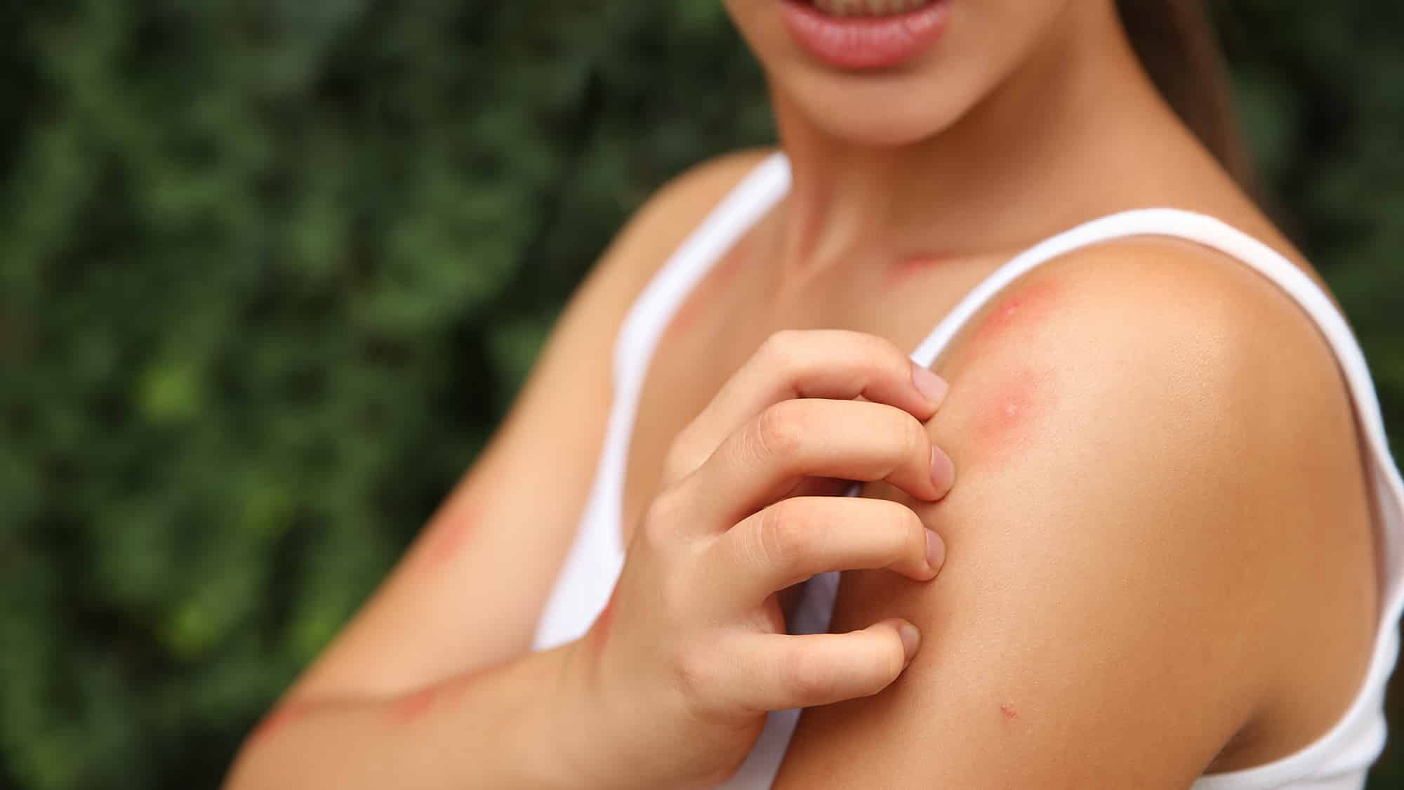 Relieves bug bites - Ways to use raw shea butter