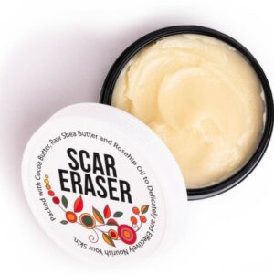 scar cream, scar eraser body butter